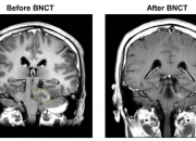 液体胶水成分有望提升硼中子俘获疗法治癌的适用范围