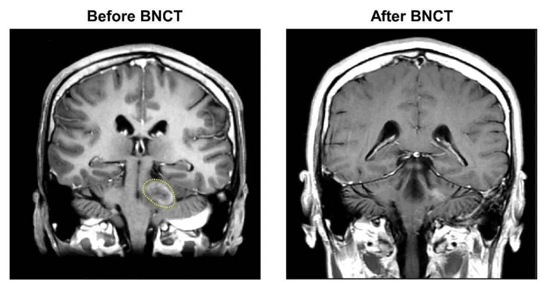 液体胶水成分有望提升硼中子俘获疗法治癌的适用范围