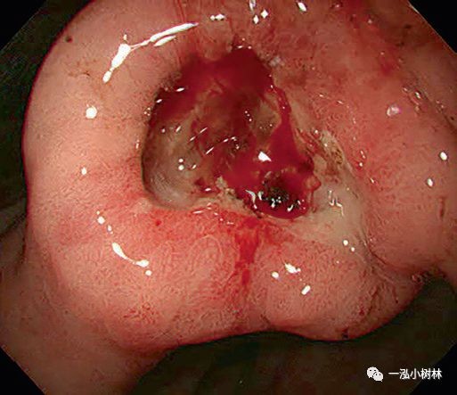 泰恩康CKBA乳膏玫瑰痤疮临床再提速：IIa期数据亮眼，IIb期提前启动